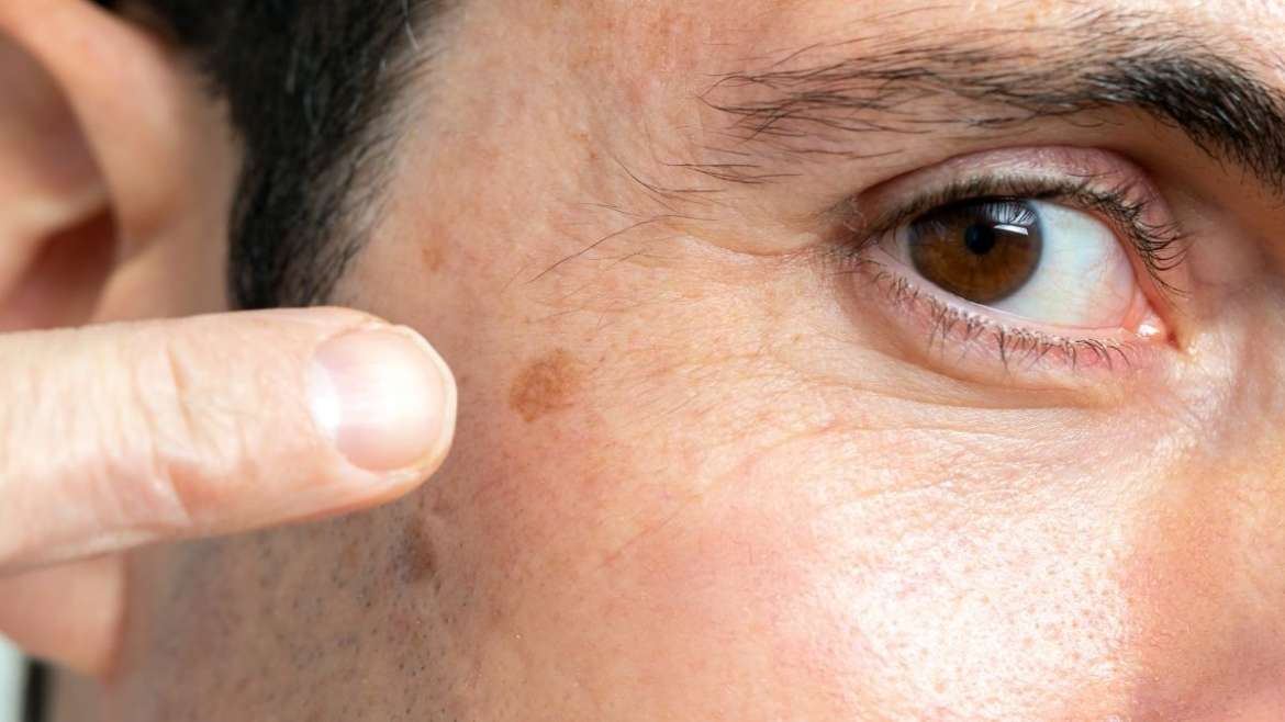 Common Dark Spots on the Face  Advanced Dermatology of the Midlands